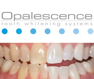 Opalescence Teeth Whitening - Dr. Michael Woolbert